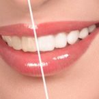 whitening_subpages whitening_subpages